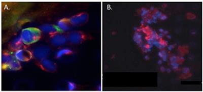 Corrigendum: Hyaluronan, Cancer-Associated Fibroblasts and the Tumor Microenvironment in Malignant Progression